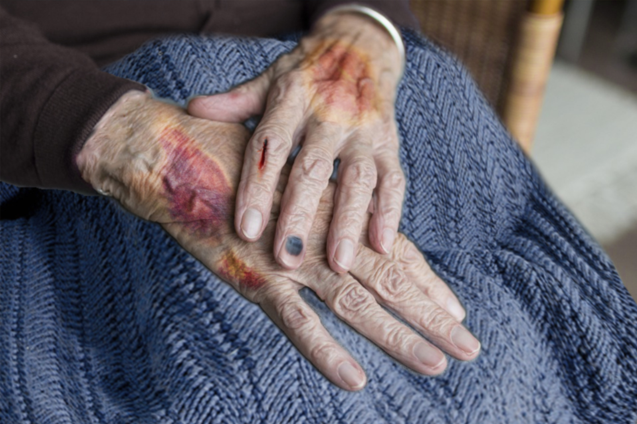 Dean Burnetti Law represents victims of nursing home abuse